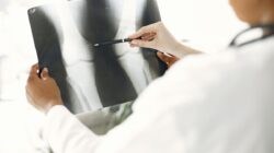 5 Kiat Cegah Osteoporosis: Tulang Tetap Kuat!