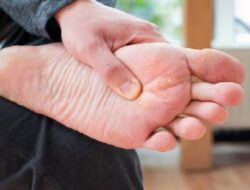 Penyebab Mata Ikan di Kaki dan Cara Mengobatinya – Tips Terbaik